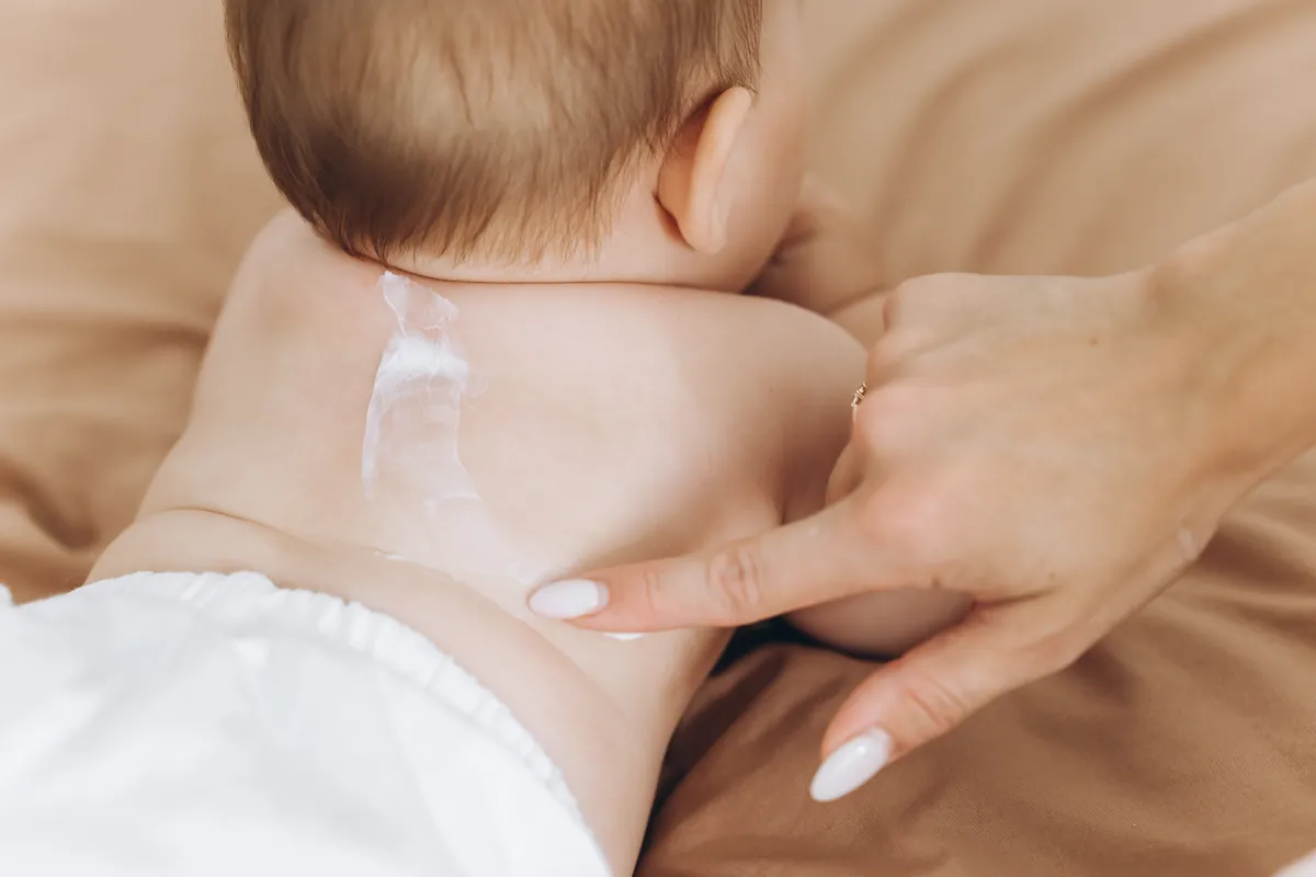 Sarpullido por calor en bebés: ¿Qué es y cómo tratarlo?