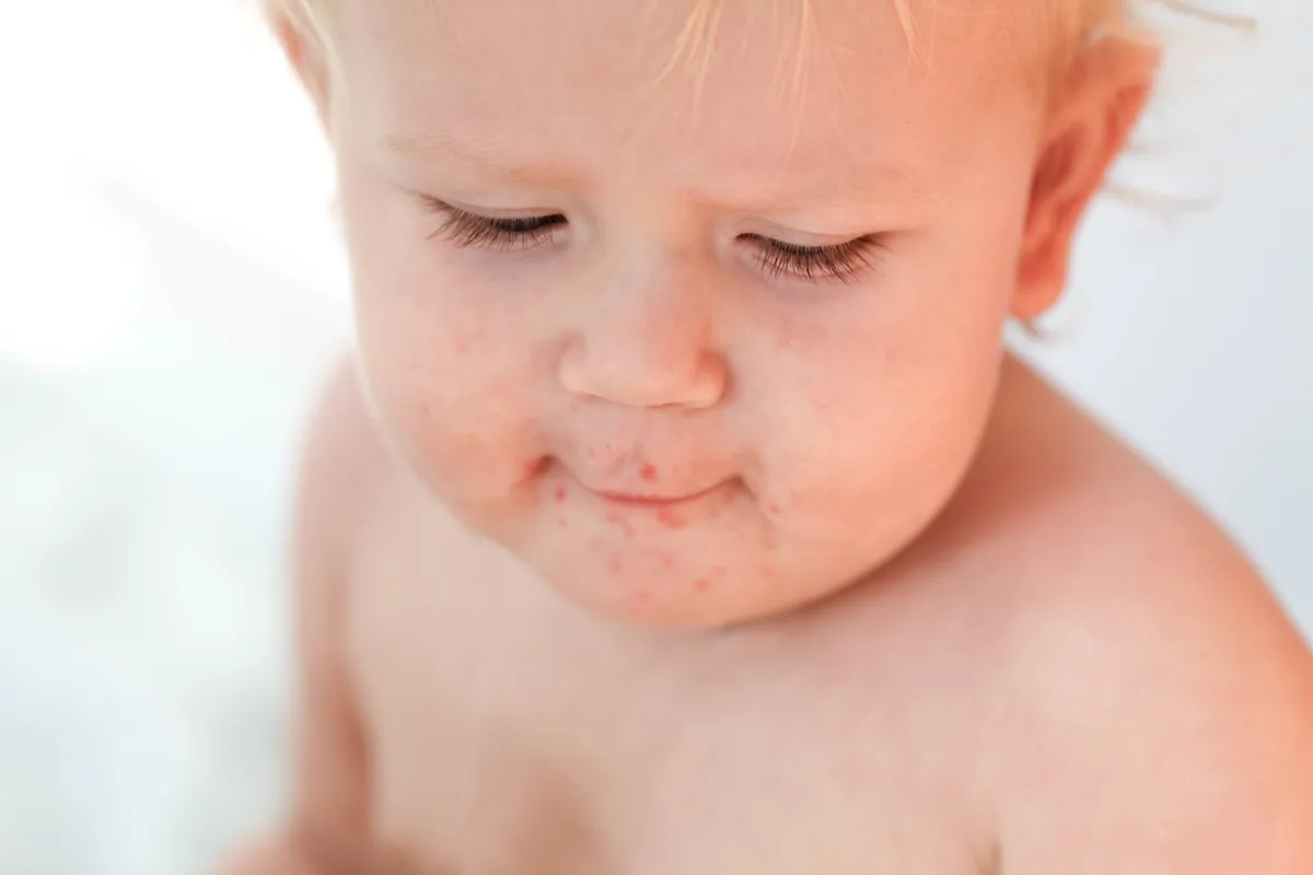 Brotoeja em bebê: o que é e como tratar?
