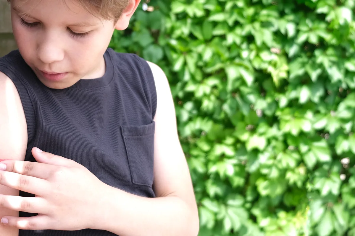 What’s the best way to treat insect bites that itch?